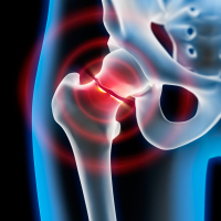 Ilustración de rayos X de la articulación de la cadera rota