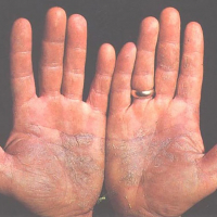 Placas de psoriasis en las dos palmas de las manos